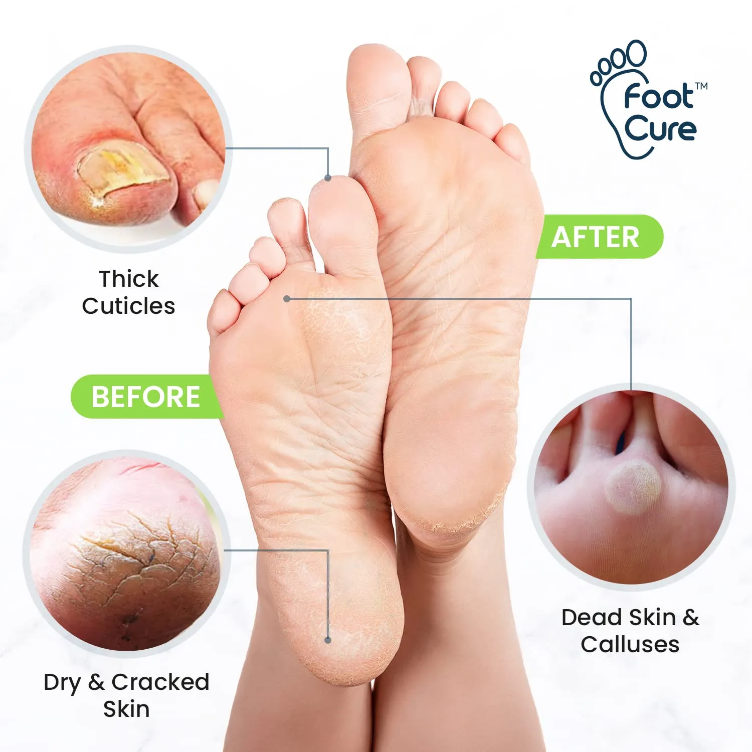 Toenail Fungus Treatment Extra Strength - Advance nail fungus treatment for fingernails, nail repair, toenail softener, yellow toenail treatment, ingrown nail and foot fungus treatment extra strength