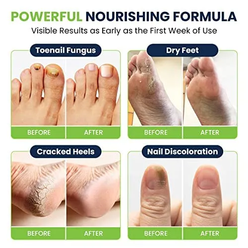 Toenail Fungus Treatment Extra Strength - Advance nail fungus treatment for fingernails, nail repair, toenail softener, yellow toenail treatment, ingrown nail and foot fungus treatment extra strength